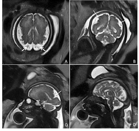 Figure 1 From Neuropathological Hallmarks Of Brain Malformations In