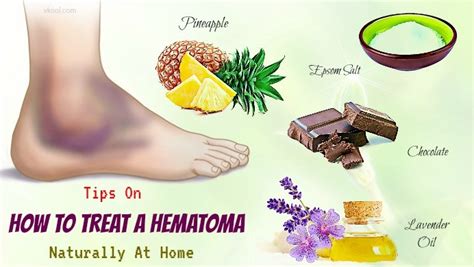 38 Tips On How To Treat A Hematoma Naturally At Home