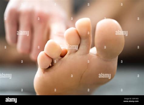 Athlete Foot Fungal Infection Itching Between Toes Stock Photo Alamy