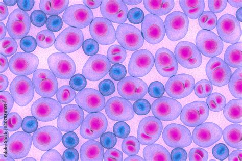 Multiple Myeloma Multiplex Leukemia Cancer 3d Color Render Illustration