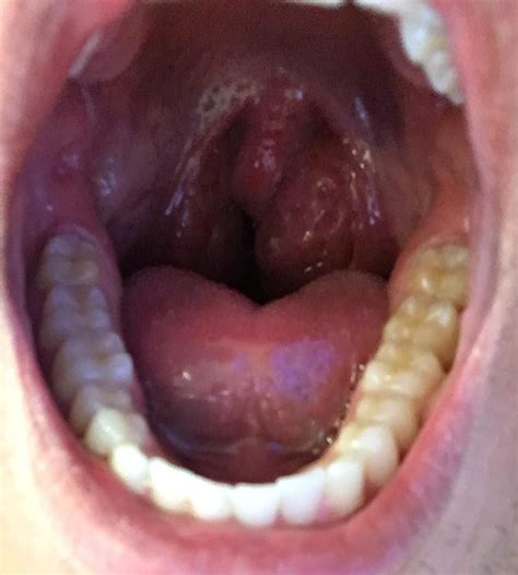 Tonsil Stones Or Just Enlarged Tonsils Tonsilstones