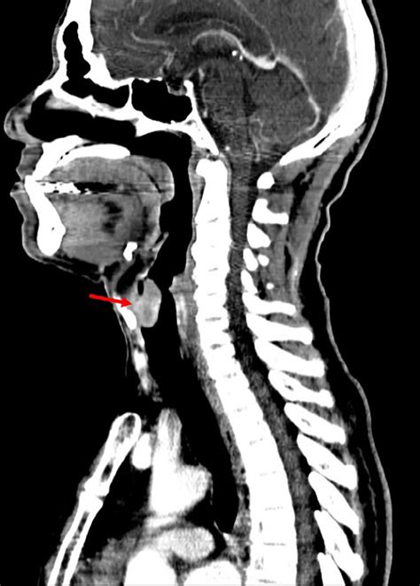Sagittal Ct Of The Neck Demonstrates The 25 Cm Oval Enhancing Mass