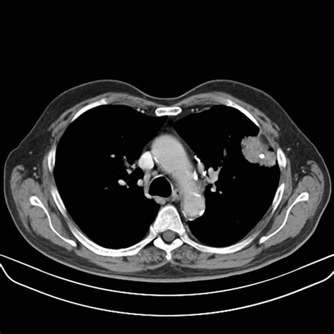 Squamous Cell Carcinoma Of The Lung Ct Wikidoc