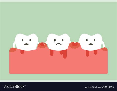 Periodontitis And Bleeding Royalty Free Vector Image