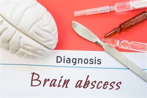 Brain Abscess Causes Symptoms And Treatment Clicks Health Hub