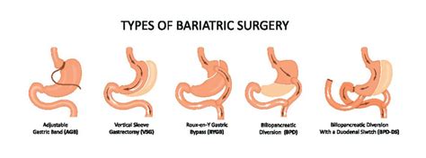 Bariatric Surgery The Johns Hopkins Patient Guide To Diabetes