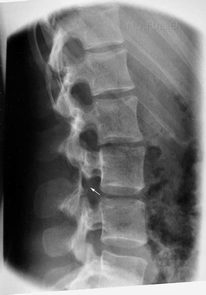 Oblique Lumbar Spine Technique Wikiradiography