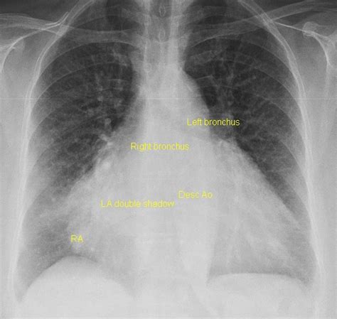 Biatrial Enlargement On Chest X Ray All About Cardiovascular System