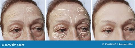Woman Elderly Face Wrinkles Correction Contrast Before And After