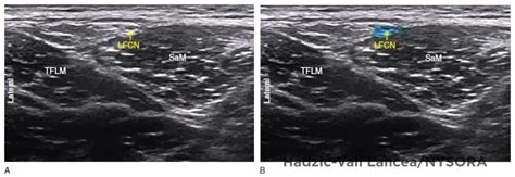 Ultrasound Guided Lateral Femoral Cutaneous Nerve Block Nysora The