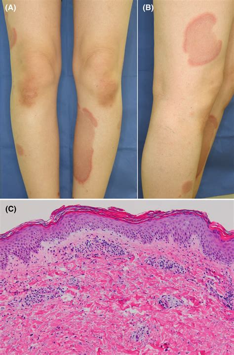 Clinical And Histopathological Features A B Asymptomatic Multiple