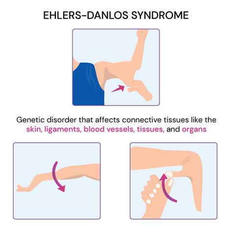 23 Signs You Grew Up With Ehlers Danlos Syndrome 2023