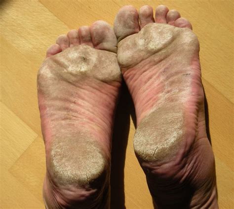 Managing Your Dry And Cracked Heels Healthmark Foot And Ankle Associates