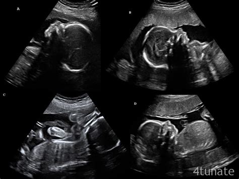 Pregnant With Quadruplets Ultrasound