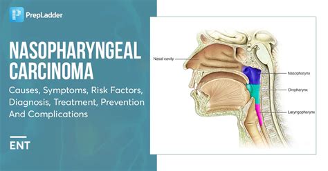 Nasopharyngeal Carcinoma Causes Symptoms Risk Factors Diagnosis