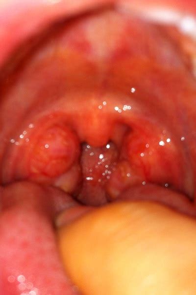 Big Tonsils Take Them Out Pics Mumsnet