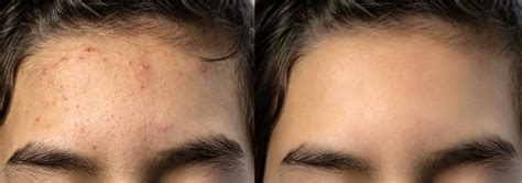 Pimples On Forehead How To Have Clear Bright Skin Healthwire