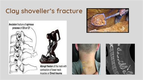 Clay Shovellers Fracture Cervical Spine Fracture C7 Fracture