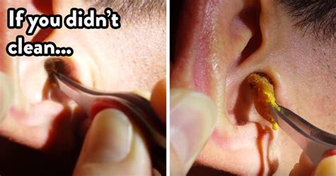 Causes And Brilliant Tips For Removing Earwax At Home Ear Wax Ear Wax Removal Ear Wax Buildup