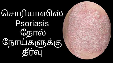 Psoriasis Cure Skin Disease Cancer Wheatgrass சொரியாஸிஸ் தீர்வு