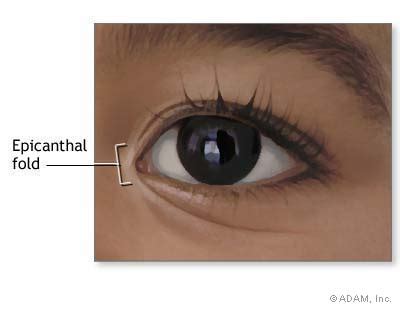 An epicanthic fold, epicanthal fold, or epicanthus is a skin fold of the upper eyelid (from the nose to the inner side of the eyebrow) covering the inner corner (medial canthus) of the eye. The New York Times > Health > Image > Epicanthal Fold
