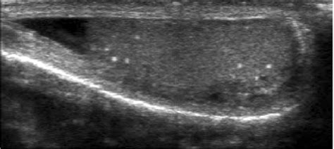 Ultrasonographic Image Of Testicular Microlithiasis Grade 1 Download Scientific Diagram