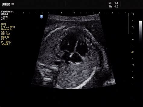 Ultrasound Images Fetal Heart B Mode Echogramm №627