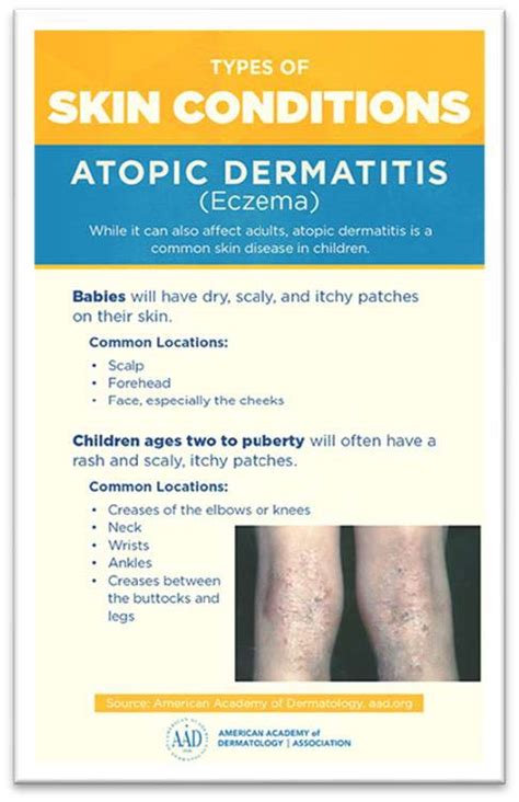 Atopic Dermatitis Eczema Diagnosis And Treatment Dermatology Surgery