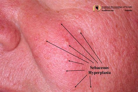 Sebaceous Hyperplasia Lips Treatment