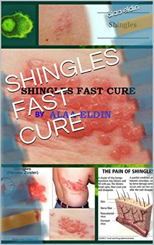 Shingles Fast Cure Kindle Edition By Eldin Alaa Health Fitness