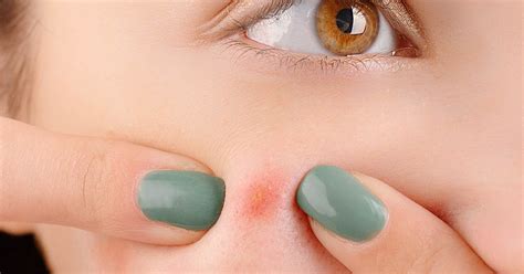 What Is Cystic Acne Understanding The Most Severe Form Of Acne Sweet