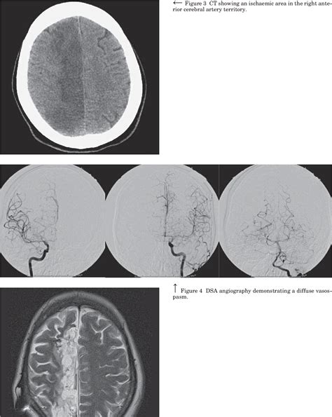 Figure 1 From Symptomatic Anterior Cerebral Artery Vasospasm After