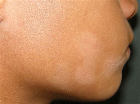Light Spots On African American Skin