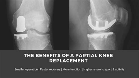 Partial Knee Replacement Faster Recovery