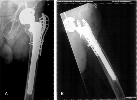 Reattachment Of Complex Femoral Greater Trochanteric Nonunions With