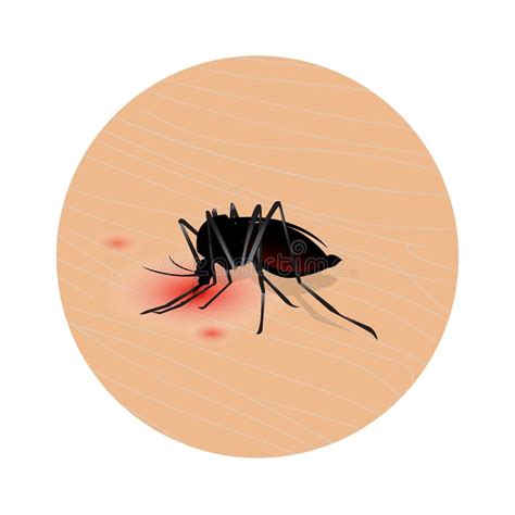 Mosquito Bite On Skin Drinks The Blood Bloodsucking Pest