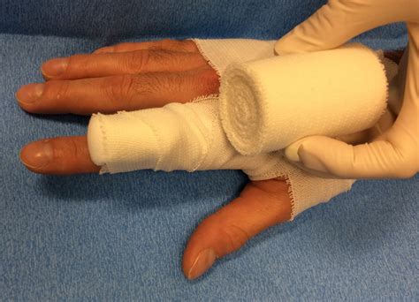 Hand Trauma Allianz Erste Hilfe Bei Handverletzungen