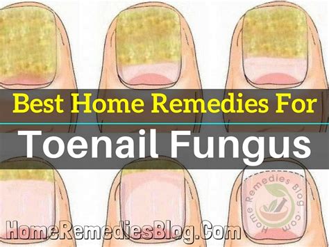12 Best Home Remedies For Toenail Fungus Home Remedies Blog