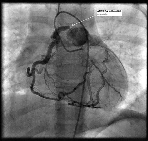 Anomalous Origin Of The Right Coronary Artery From Pulmonary Artery