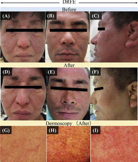 Clinical And Dermoscopic Findings Of Facial Eruptions Before And After