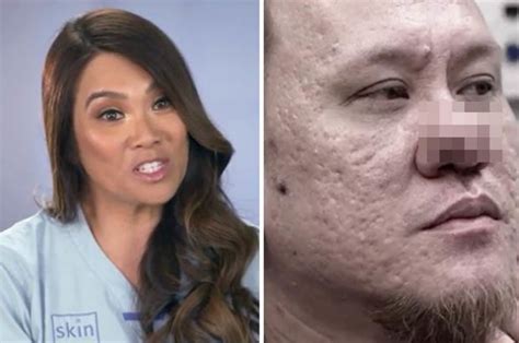 Tlc Dr Pimple Popper Man Finally Gets ‘painful Cyst Burned Off Nose