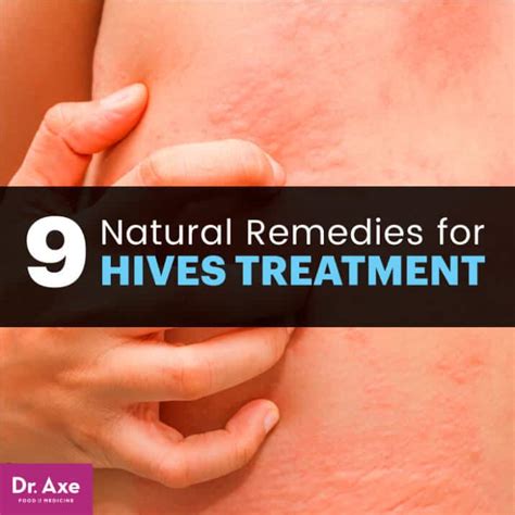Hives Treatment 9 Natural Remedies For Soothing Relief Dr Axe