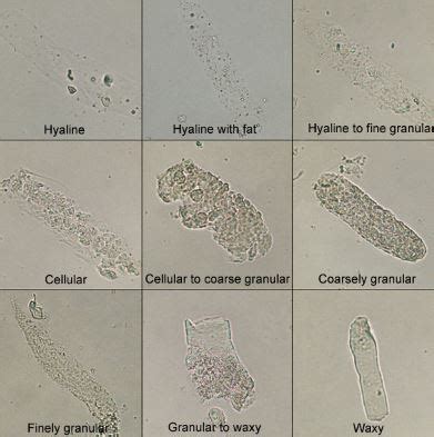 Hyaline Casts In Urine High Clinical Significance Examination