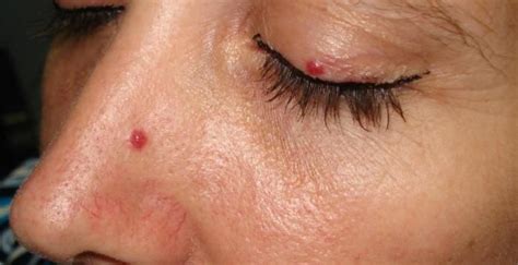 Cherry Angioma Definition Causes And Home Remedies Body Remedy Skin