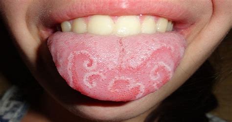 What are the possible causes of bumps under my tongue? 10 Strange Medical Conditions You've Never Heard Of ...