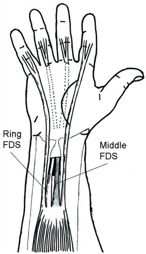 Tendon Transfers Part I Principles Of Transfer And Transfers For