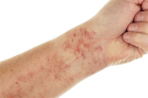 What Does Lupus Rash On Arms Look Like
