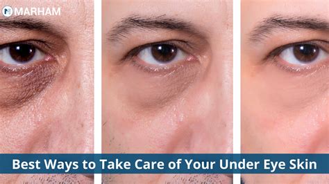 How To Take Care Of Your Under Eye Skin Marham