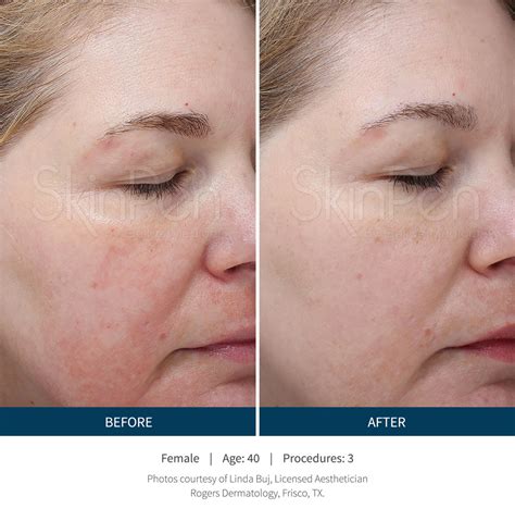 Before And After Skinpen Bellus Medical