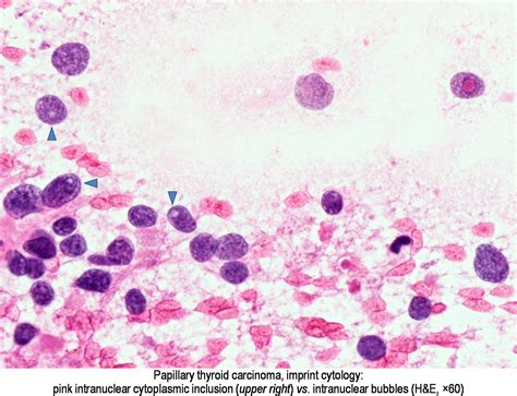 Papillary Thyroid Carcinoma Pathology Outline